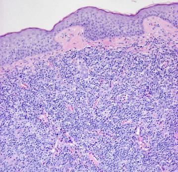 erytrhoderma + keringő