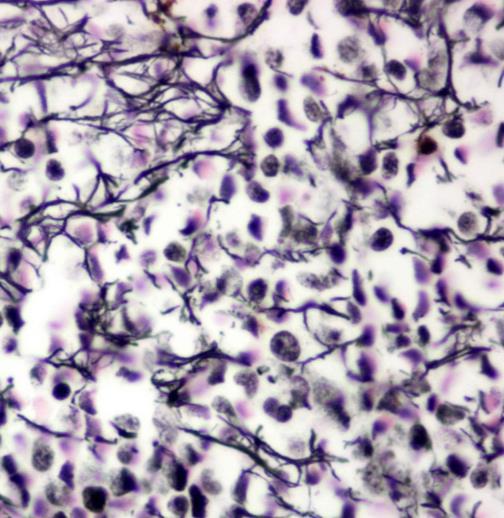 Phenotípus: CD20+, CD 11c+,