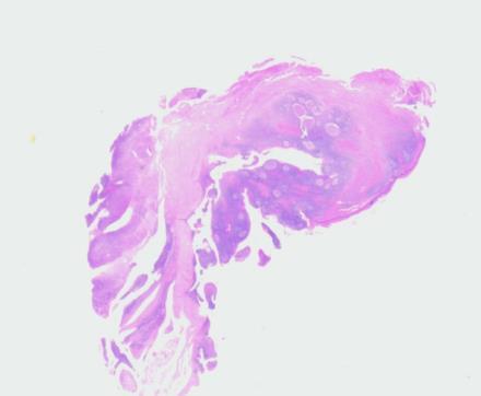 scd3-, ccd 3+, CD 56+, CD 8 +/-, CD4-, TIA +