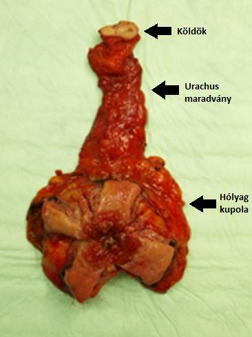 2.9 Az urachus carcinoma kezelése 2.9.1 Sebészi kezelési lehetőségek Az UrC lokális eseteiben elsődlegesen a sebészi terápia választandó, mely napjainkig az egyedüli kuratív kezelés.