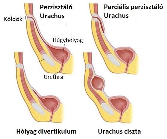 1. ábra: Az urachus maradány néhány jellegzetes formája (forrás: http://www.medbullets.com/step1-embryology/3008/umbilical-cord-and-remnants) 2.