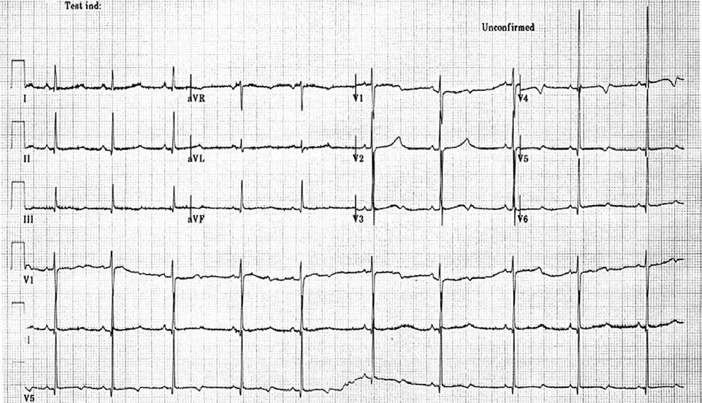 1. ábra. A proband 11 éves korából származó EKG-felvétele, amely QT-megnyúlást mutat (QTc: 550 ms), atípusos T-hullám morfológiával. Papírsebesség 25 mm/sec, hitelesítés 1 mm/mv.