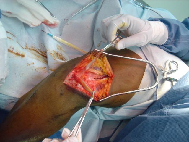 B) Quadriceps ínnal történő LCA-pótlás A quadriceps ínnal való elülső keresztszalag-pótlás szintén a lehetséges alternatívák közé tartozik.