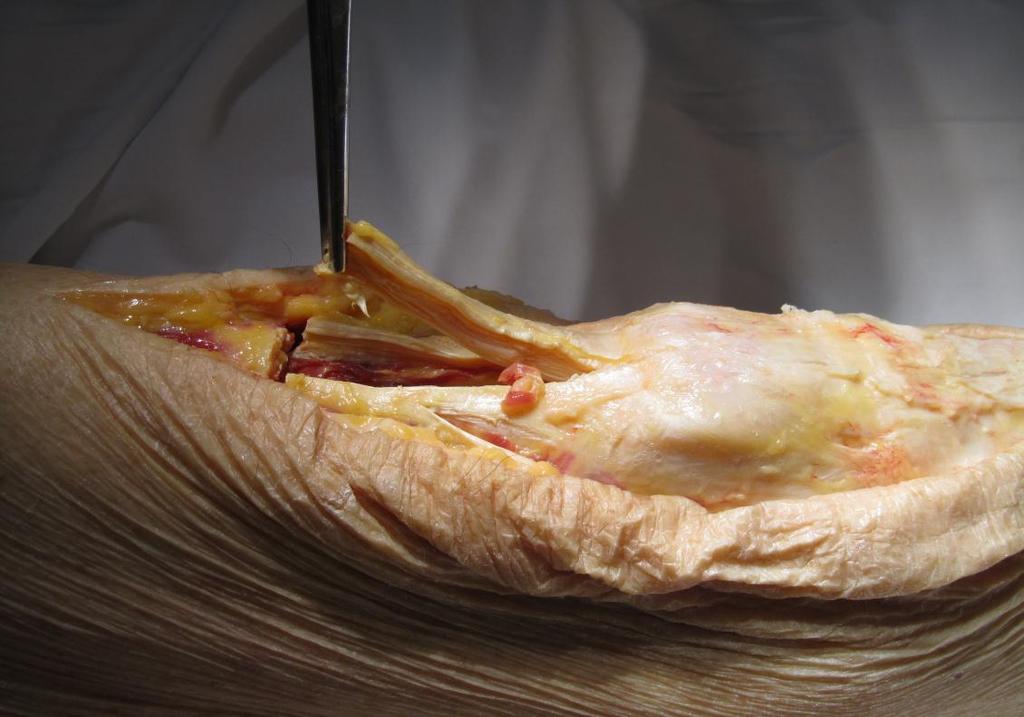 10. ábra: Quadriceps ín preparálása human