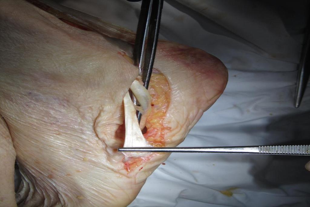 12. ábra: Peroneus longus ín látható - alávetett csipesszel jelezve human kádáveren. Csipesszel megfogva pedig s peroneus brevis ín seprűszerű tapadása látható az V.