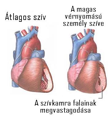 A vérnyomás emelkedésére utaló tünetek, panaszok Sajnos olyan általános panaszokról van szó, amelyeket sok más betegség is okozhat.