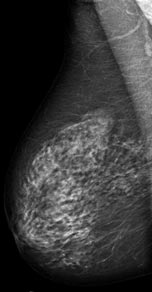 Az alábbi felvételek öt különböző, normális emlő mammográfiás mintáját ábrázolják.