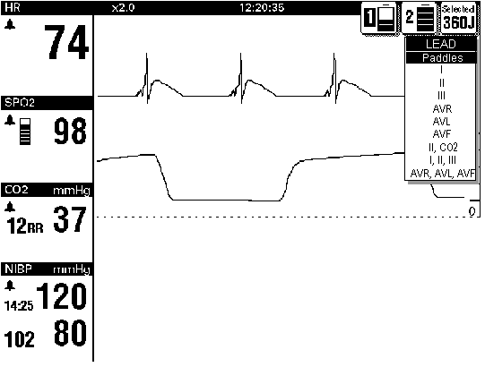 MONITOROZÁS EKG MONITOROZÁS A következő szakaszban tárgyalt témakörök: Az EKG-monitorozással kapcsolatos figyelmeztetés Az EKG-elvezetés és a méret kiválasztása A szisztolés hangjelzés erősségének