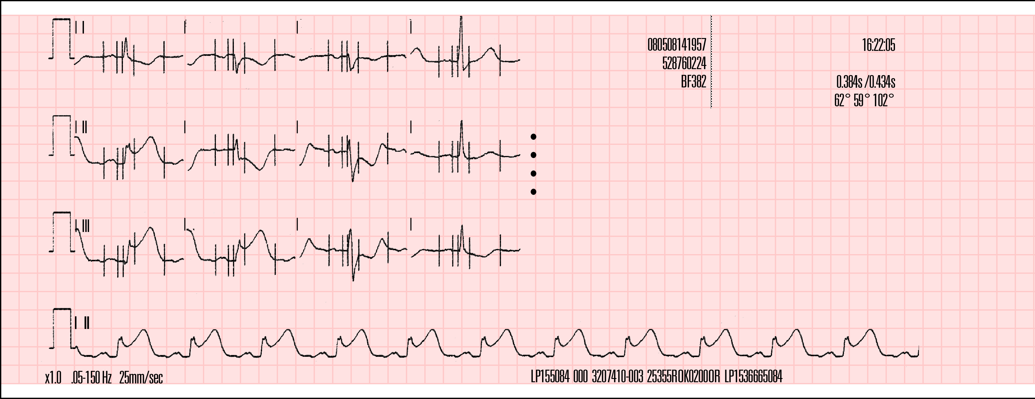 ábra Példa a kinyomtatott 3 csatornás, cabrera típusú, 12 elvezetéses EKG-jelentésre A 4 csatornás formátum A 4-9. ábra és a 4-10.