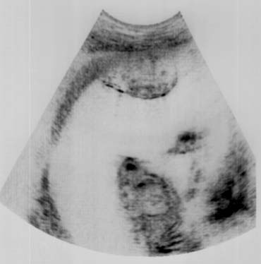 3. ábra: Súlyos feto-fetalis-transfusiós szindróma a terhesség 20. hetében. A polyuriás recipiensnél polyhydramnion látható, míg az anuriás donor a rásimuló membrán által a lepényhez simulva látható.