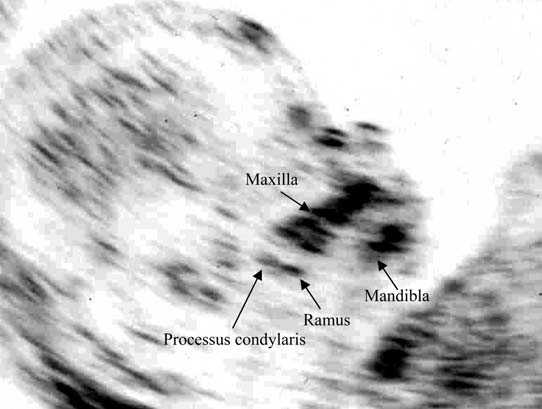 2. ábra: A maxilla mérése 12 hetes magzaton. Fül hossz A postnatalis életben a Down kóros újszülöttek egyik legjellemzoy bb és egyben legállandóbb klinikai jegye a kicsi fül.