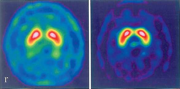 DAT SPECT DRD-ban Nincs DAT csökkenés Huang CC, et al.