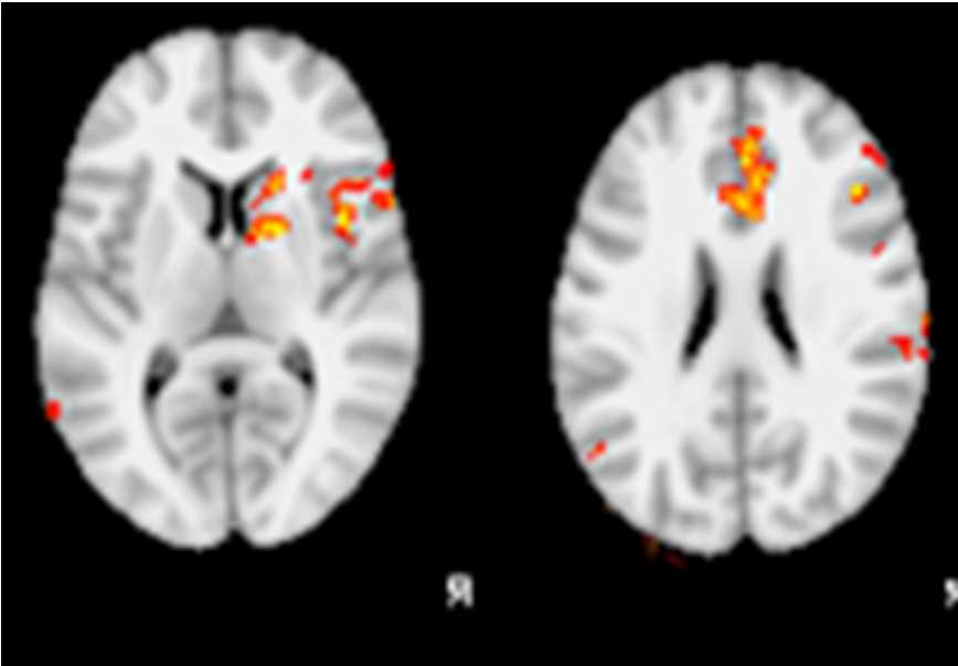 Fájdalom agykérgi reprezentációja a pain matrix Primary sensory cortex (SI) Secondary sensory cortex (SII) Insular cortex (IS) Anterior cingulate cortex