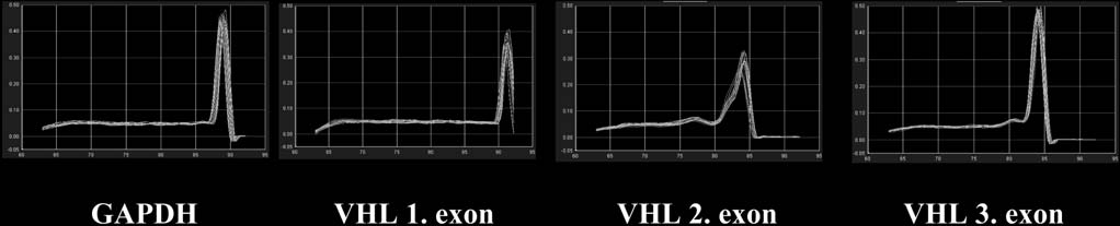 2. táblázat Von Hippel Lindau-szindrómában szenvedő hazai indexbetegekben kimutatott heterozigóta VHL gén mutációk és deletiók Indexbeteg sorszáma Életkor, nem A betegség klinikai megjelenése A VHL