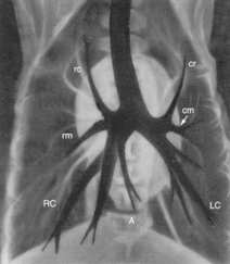 A tüdı röntgenképe Bronchusok Normál tüdırajzolat