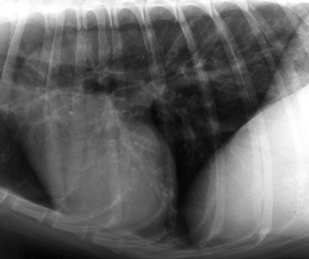 eosinofil sejtes pneumonia Bronchialis