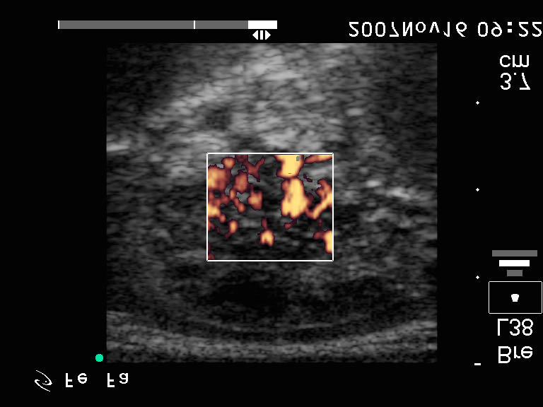 Számos apró, fényes pont - azaz microcalcificatio is jól megfigyelhetõ, az amorf nagyobb echogazdag gócok