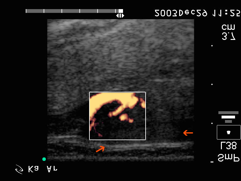 -felsõ harmad, hosszmetszet, Power Doppler-mód. Itt egyértelmû, hogy nem izomrostról, hanem göbrõl van szó, a jelzett helyen?