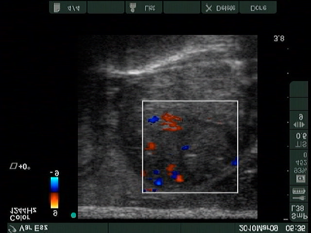 kép: adenoma microfoll. (hist). Bal lebeny harántmetszet, color Doppler. Az intranodularis keringés fokozott.