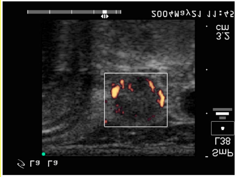 A göbtõl dorzomediális mutatkozó echoszegény 5-6 mm-s sáv????gyanús parenchymába terjedõ daganatra. 55. eset 2.