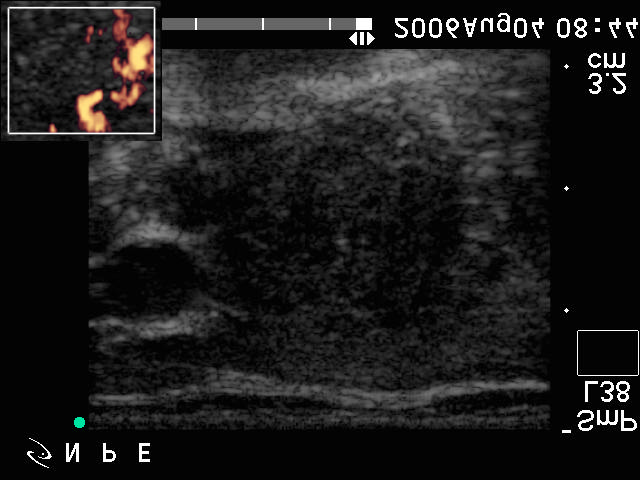 57. eset 1. kép: inzuláris ca. Jobb harántmetszet, inzert Power Doppler. Echoszegény, inhomogén, elmosódott határú göb.