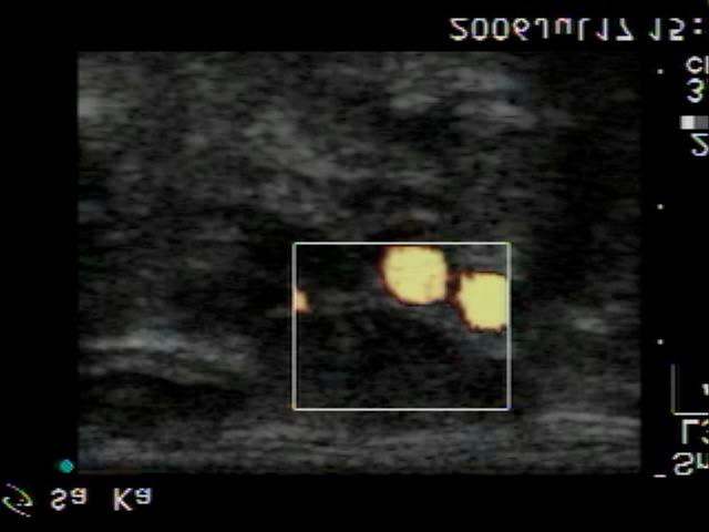 kép: medulláris ca. nyirokcsomó áttéte. Nyak jobb oldalának UHvizsgálata, Power-Doppler-mód.