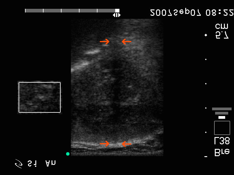 eset 2. kép: medulláris ca. Bal lebeny hosszmetszet, inzert Power Doppler.