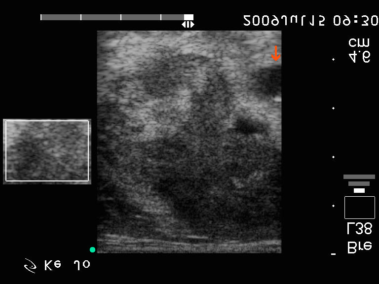 kép: anaplasticus ca. Jobb lebeny harántmetszet, inzert Power Doppler.