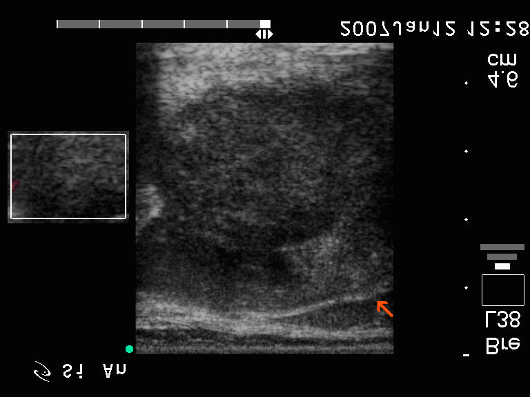 64. eset 1. kép: Hashimoto talaján kialakult MALT-lymphoma. Jobb lebeny harántmetszet, inzert Power Doppler. Az echoszegény, látótérbe bele nem férõ tumor mellett a jelzett részen?