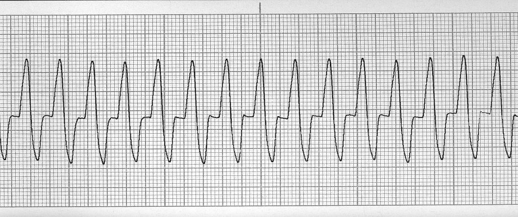 Szívfrekvencia190/p. A felvételen valamennyi QRS kiszélesedett, alakja aberrált. A kamrai ütések kuplungideje azonos, az EKG ritmusos.