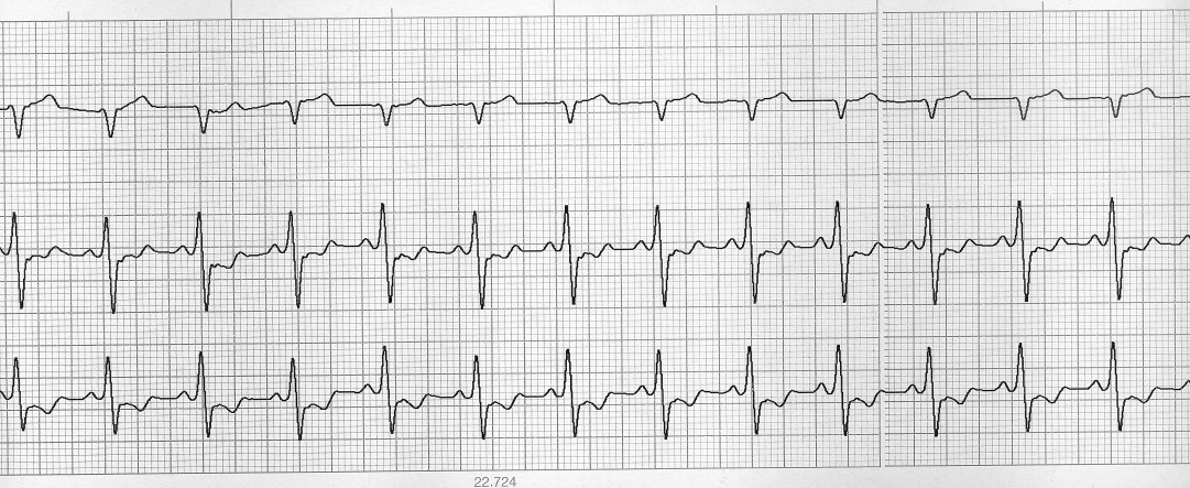 Echokardiográfiás vizsgálattal tricuspidalis billentyű dysplasiát, jobb pitvar tágulatot és jobb kamra hypertrophiátállapítottunk meg.