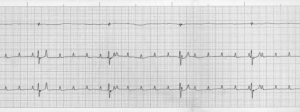 III-fokúAV-blokkrajellemzőEKG-görbe. Kamrai frekvencia 40/p, a kamrai ütéseket szabályos időben P-hullámnem előzi meg. Pitvari frekvencia 180/p, független a kamrai ritmustól.