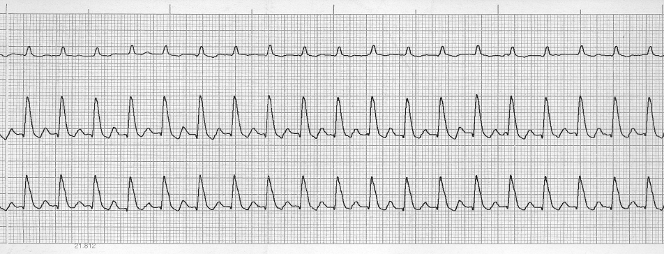 250/p szívfrekvencia, szabályos ritmus, a QRS-ek megszélesbedtek, magasabbak. A T-hullám a következő ütés P-hullámábanfolytatódik, köztük izoelektromos rész nincs. Szívtengely +80 fok.