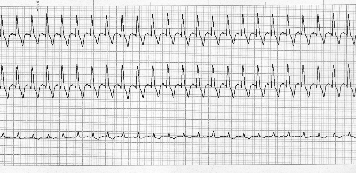 Szívfrekvencia 230/p, minden QRS-t szabályos időben P- hullámelőz meg, az I. és II. elvezetésben mély T-hullám. QRS I. és II. elvezetésben magas és széles. A szív elektromos tengelye +30 fok.