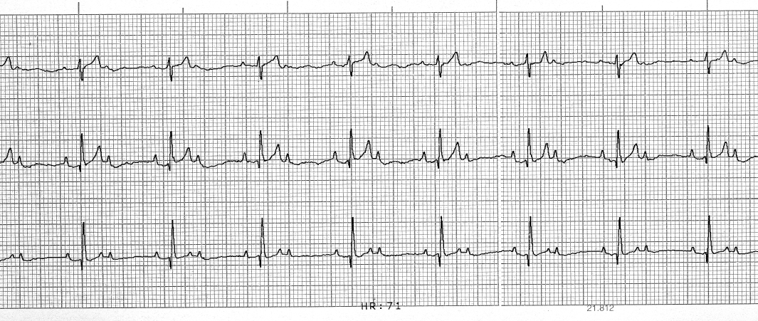 A belégzéskor, amikor a frekvencia gyorsabb, a P-hullámokmagasabbak. Kifejezett sinus arrhythmia, wanderingpacemaker.