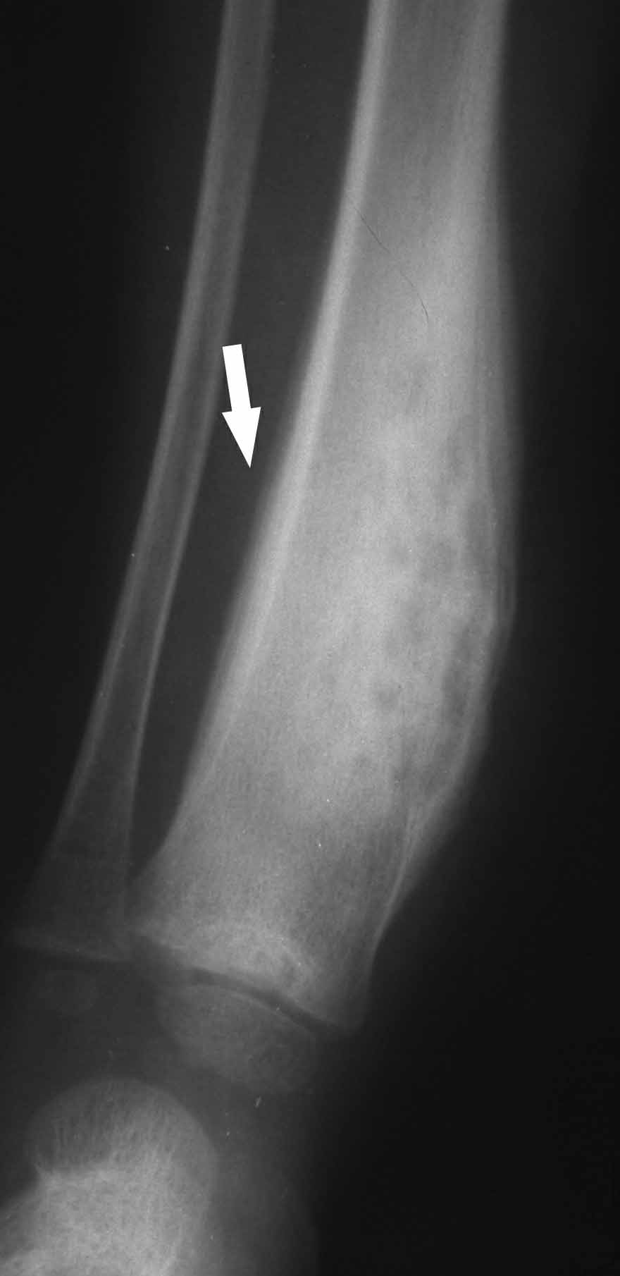 ESETISMERTETÉS A betegeknél hagyományos rtg, csontscintigraphias, MR, CT, labor, immunológiai vizsgálatokat végeztünk. Bakteriológiai tenyésztés, biopsia, histologiai vizsgálat megtörtént. 1. eset.