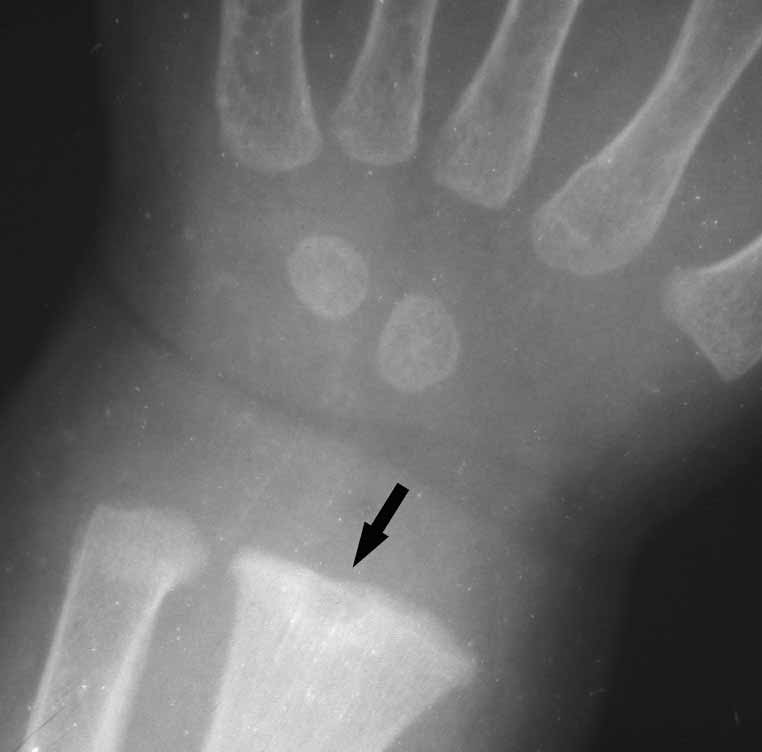 Rtg felvételen a jobb tibia distalis metaphysisén egyenetlen, scleroticus szélû felritkulás látszott, melyet lamellaris periostealis reakció kísért. A jobb radius dist.