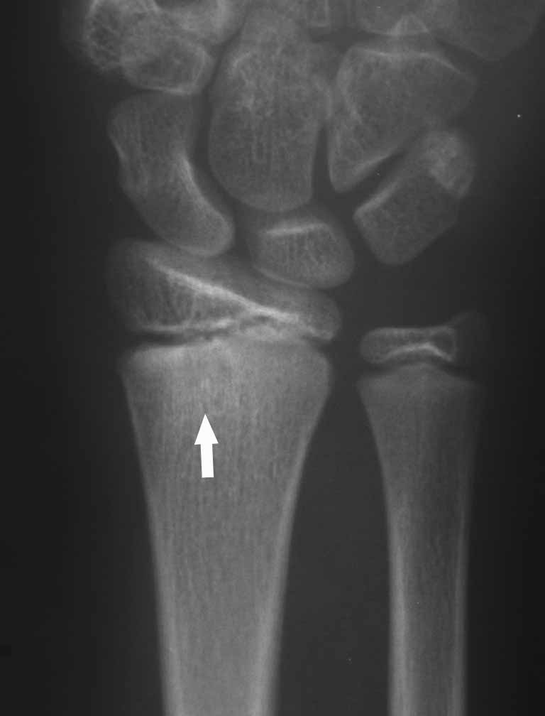 20 OSTEOLOGIAI KÖZLEMÉNYEK 2004/1 2 a 2 b 2 c 2 a kép. 11 éves fiúnál a jobb radius distalis metaphysisén többgócú apró lysis van, fõként medialisan, környezetében sclerosis látszik.