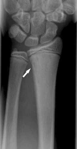 A femur distalis metaphysisén egyenetlen, inkább scleroticus csontszerkezet látszik. (2001.