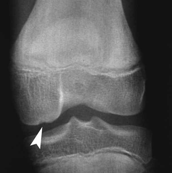 osteochondritis dissecans.