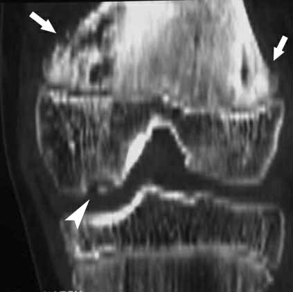 A metaphysisen a csontszerkezet normalizálódott, az osteochondritis dissecans viszont