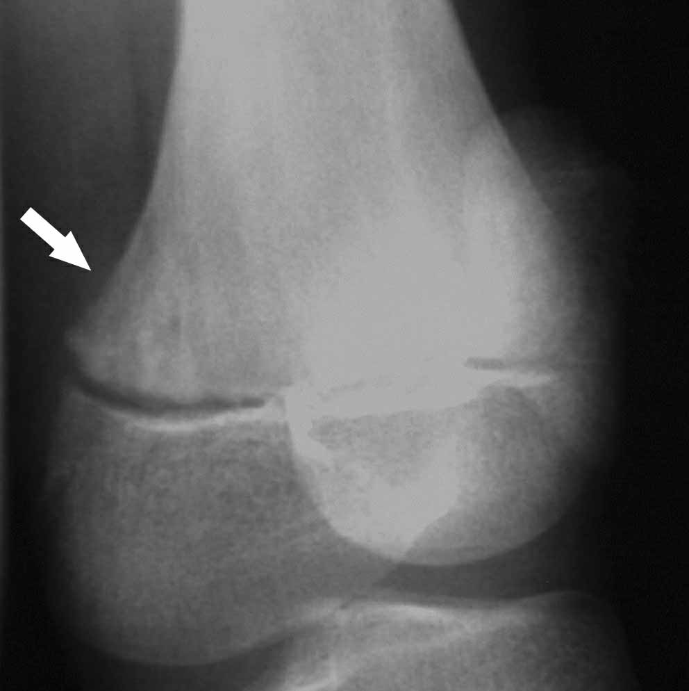 L) Tehát a régebbi térdpanaszokat az osteomyelitis okozta.