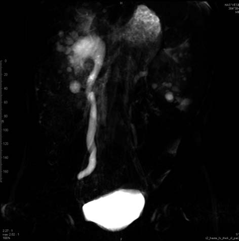 Visszahúzva az ureterkatétert és az ureterbe kontrasztanyagot fecskendezve azt látták, hogy az különösebb ellenállás nélkül, azonnal ürül a hólyagba, ezzel cáfolva a vesicoureteralis szûkület