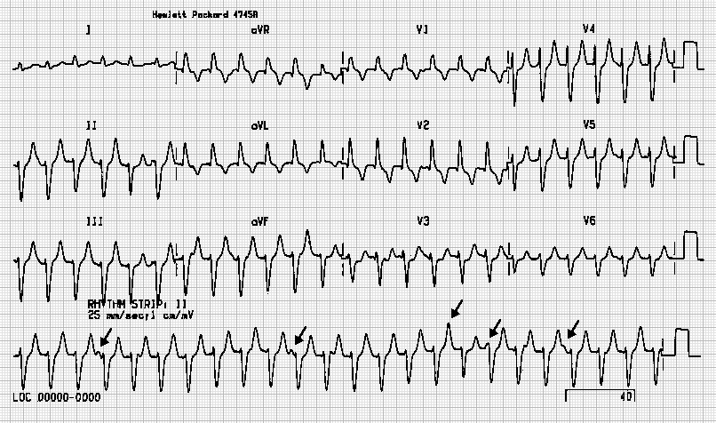 normál szinusz ritmus o mindegyik P hullámot QRS követi o P hullám aránya 60-100 ritmus per perc <10% szórással szint <60 = sinus bradycardia szint >100 = sinus tachycardia szórás >10% = sinus