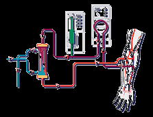 Hemodialízis Hemodialízis végzéséhez szükséges az arterio-vénás kapcsolat: AV Fistula A vért