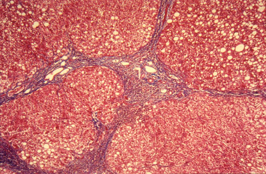 Végstádiumú májbetegség Cirrhosis End-stage fibrosis sok gyulladásos májbetegség vége. Többnyire kideríthetetlen okok. http://www.meddean.luc.