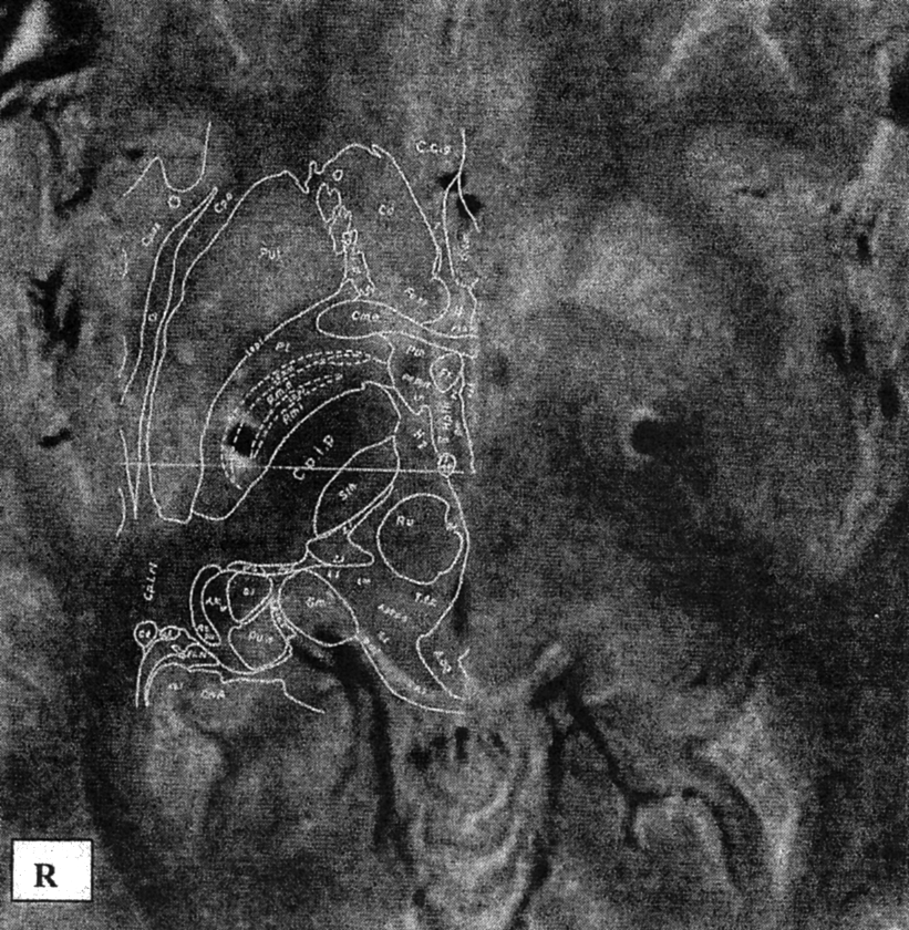 13. Ábra Posztoperatív MRI és sztereotaxiás térkép összevetése az elektróda pozíciójának pontosabb meghatározása céljából.