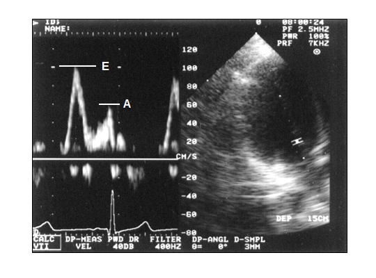 4. ábra: A bal kamra korai (E=early) és késői (A=atriális) diasztolés telítődésének csúcssebessége (in 12) Fig 4: Peak velocity of the early (E) and late (A=atrial) phase of the left ventricular