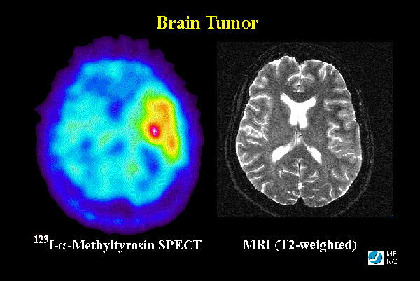Egy másik típus az agyi vérátfolyás vizsgálata ahol az agy vérellátásának zavarai diagnosztizálhatók. A néhány tipikus SPECT képet mutat be.