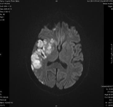 3-9 % Corticalis lokalizáció, hemosziderin Ép cortex szigetek Territoriális infarktus